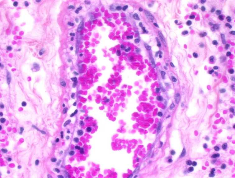 Passage des leucocytes au travers d'un capillaire dilaté